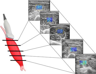 Shear wave elastography combined with electromyography to assess the effect of botulinum toxin on spastic dystonia following stroke: A pilot study